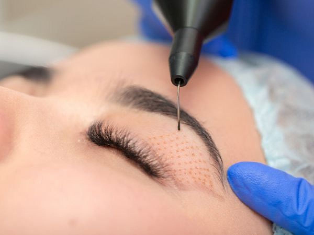 Plasma Lift à Montpellier (34) Par Sonia - Estheca