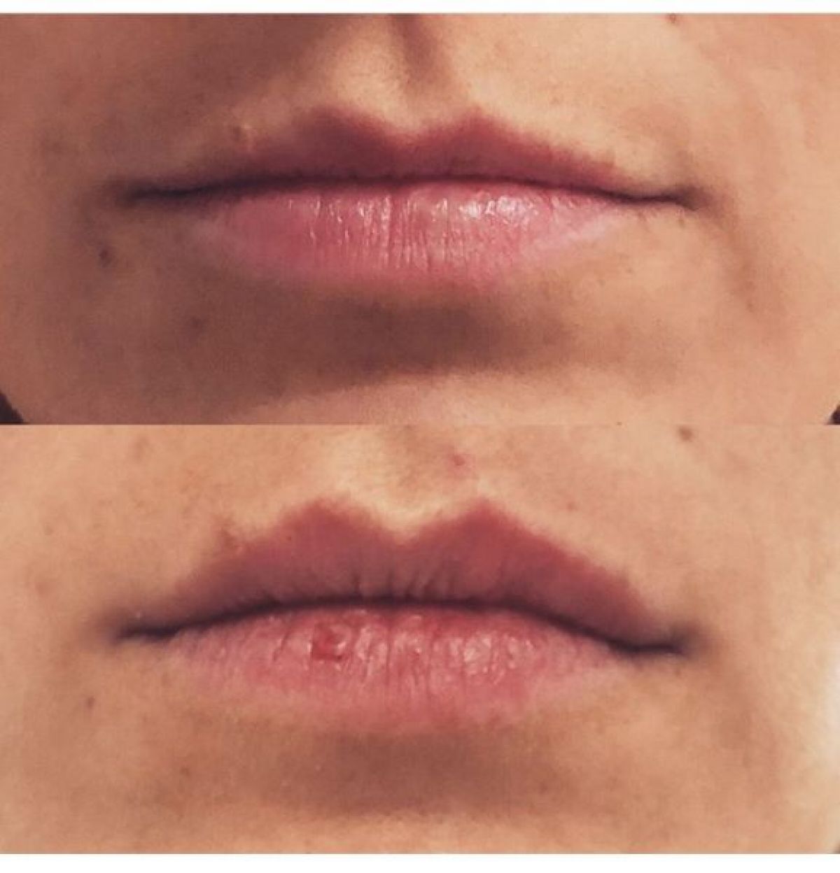 Hyaluron Pen  à Toulouse (31) Par Mme ibn - Estheca