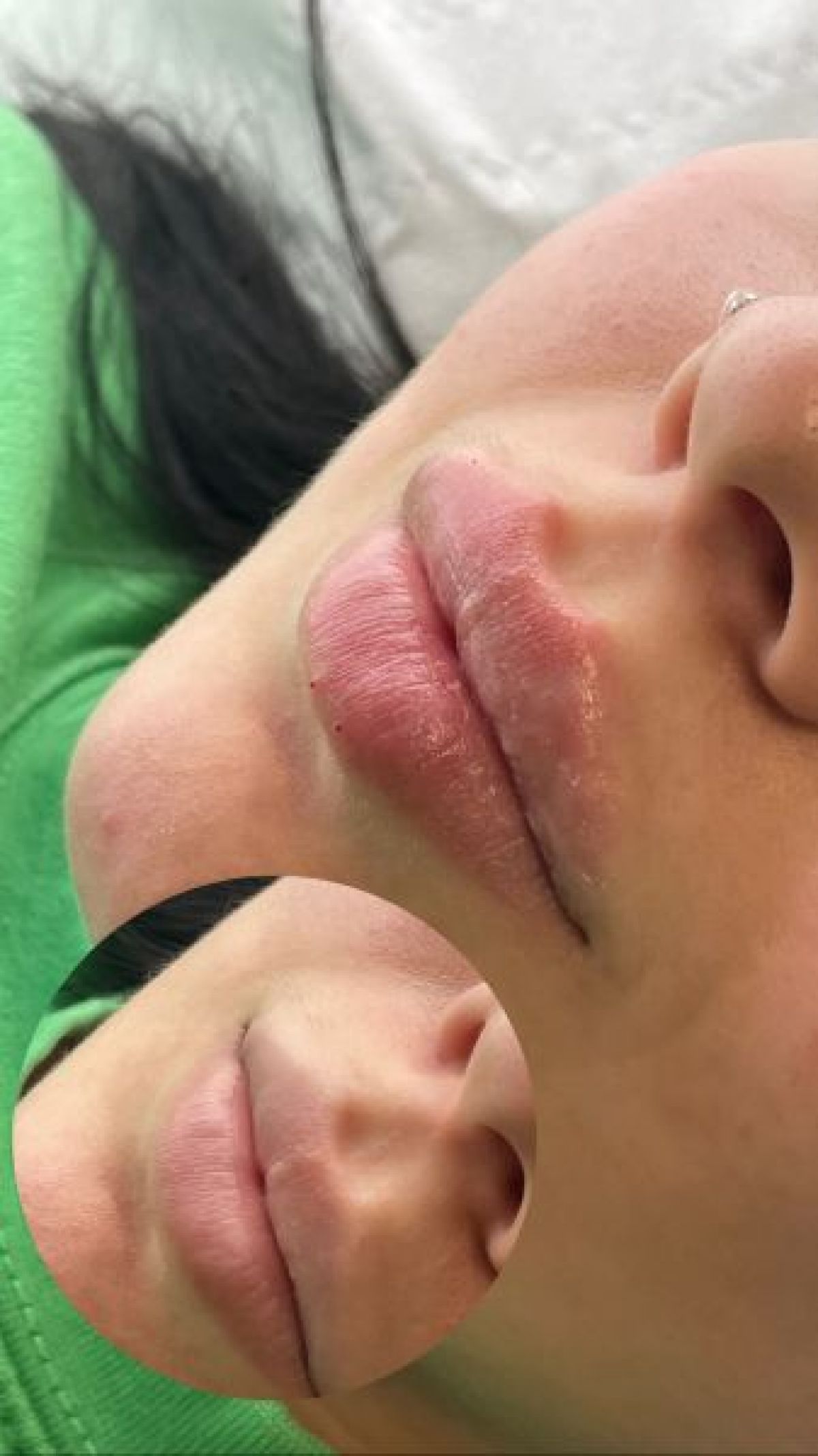 Russian lips / Augmentation des lèvres à Tours (37) Par Anais - Estheca
