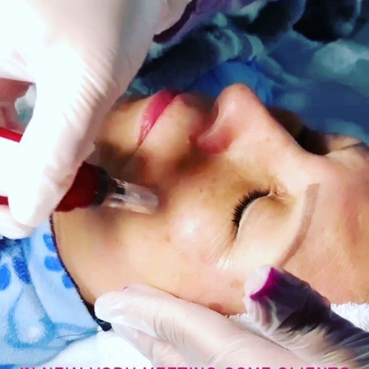 MicroNeedling BB Glow à Noisy-le-Grand (93) Par Angélique - Estheca