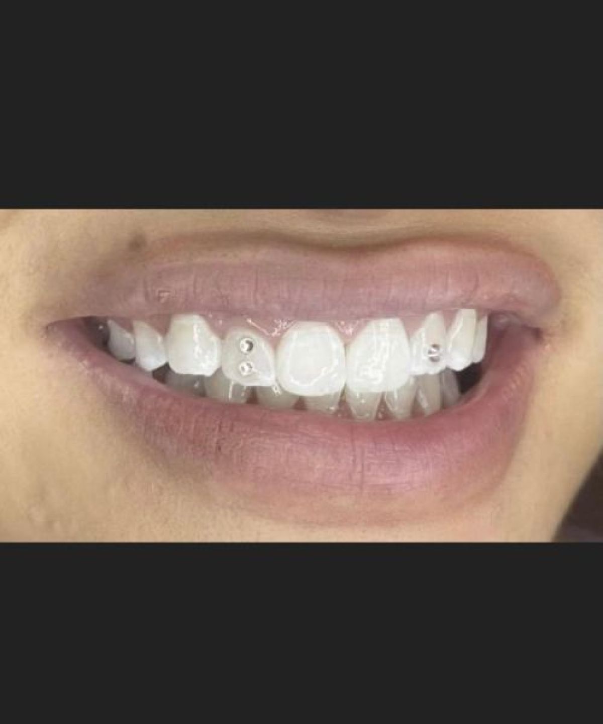 Strass Dentaires à Rennes (35) Par Sabrina - Estheca
