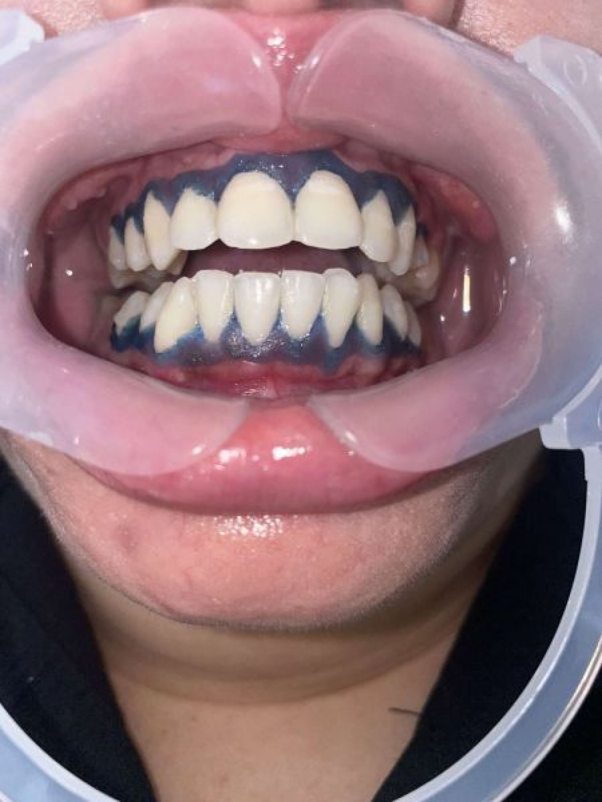 Blanchiment dentaire américain à Pinet (34) Par Laura - Estheca