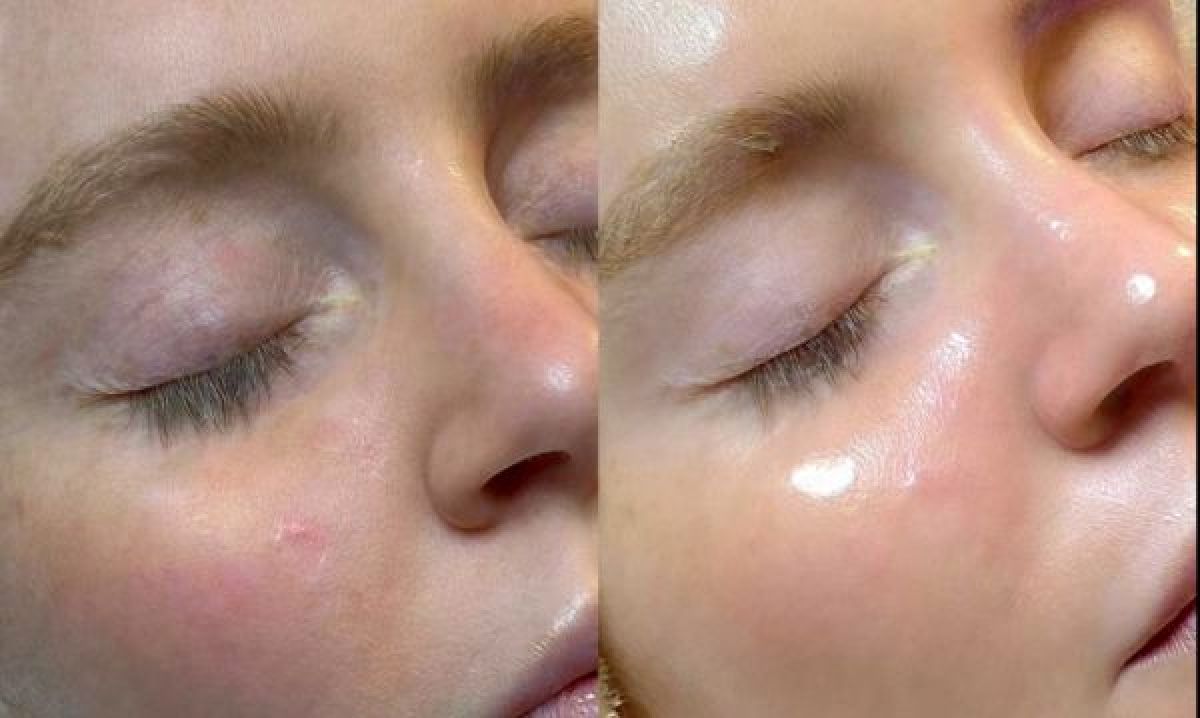 Hydraskin à Marseille (13) Par Ahlam - Estheca