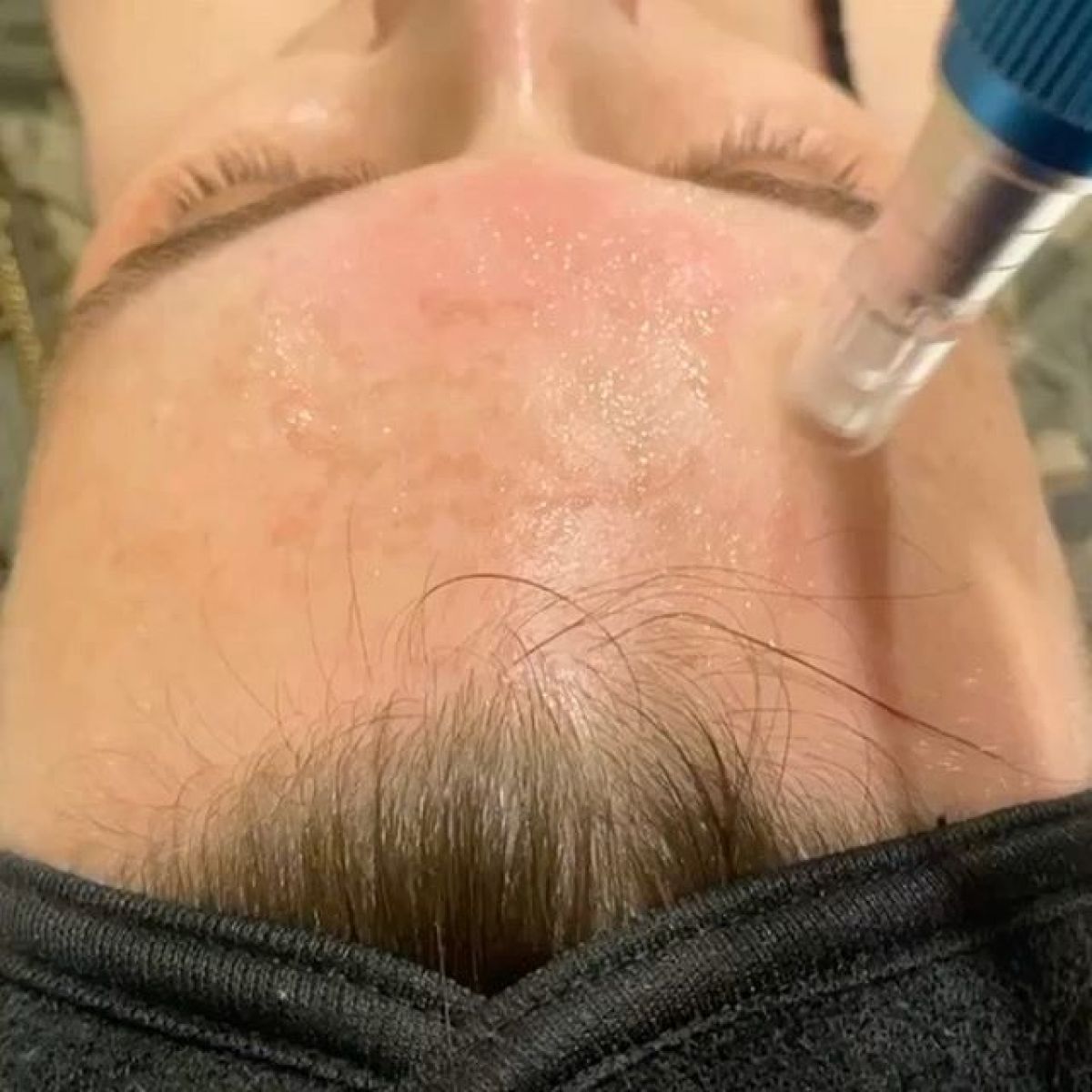 MicroNeedling BB Glow à Frontignan (34) Par Manon - Estheca