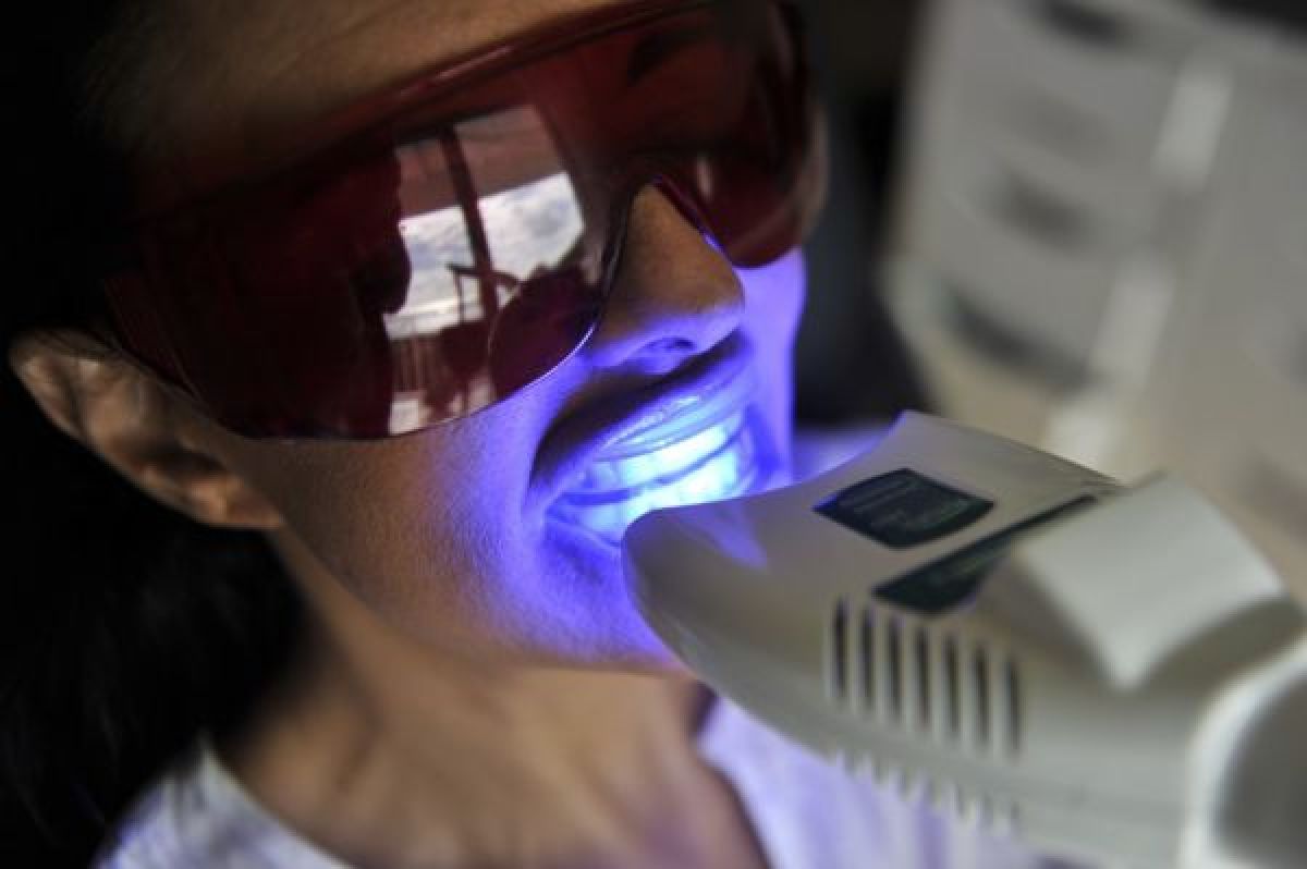 Blanchiment dentaire professionnel à Montpellier (34) Par Chloé - Estheca