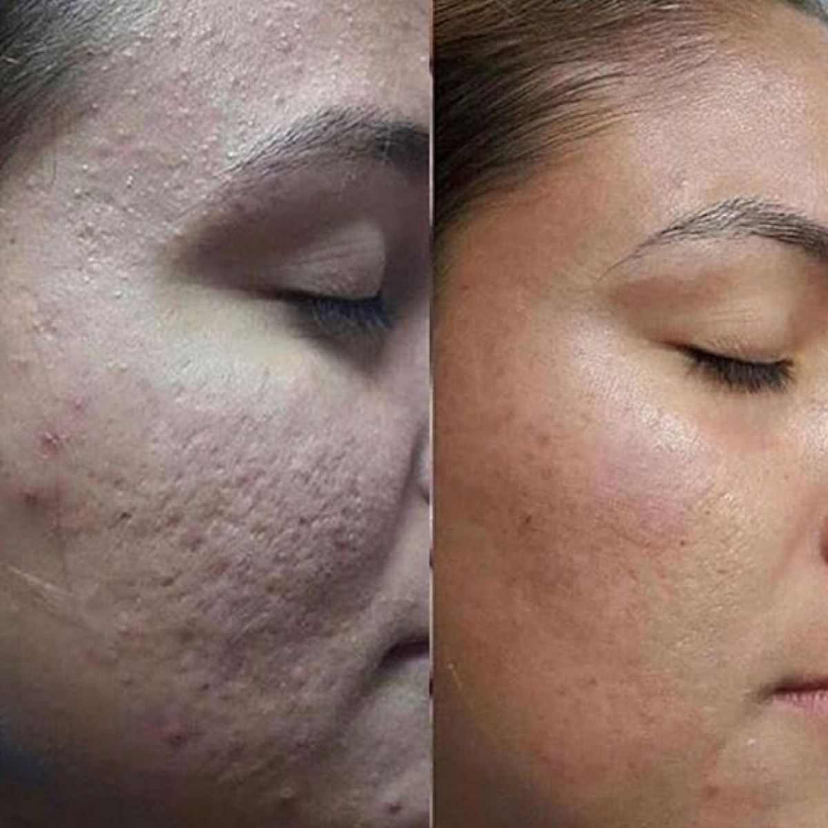 MicroNeedling BBGlow à Argenteuil (95) Par Audrey - Estheca