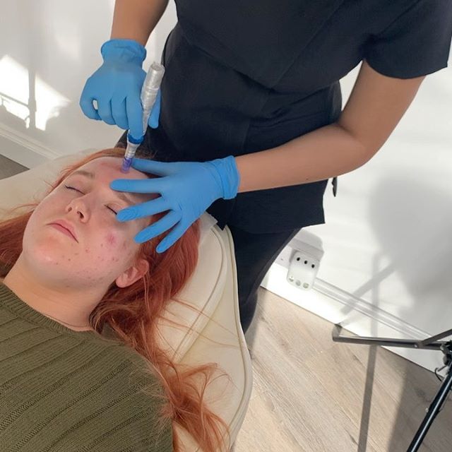 À Herblay | Microneedling | Les meilleures esthéticiennes
