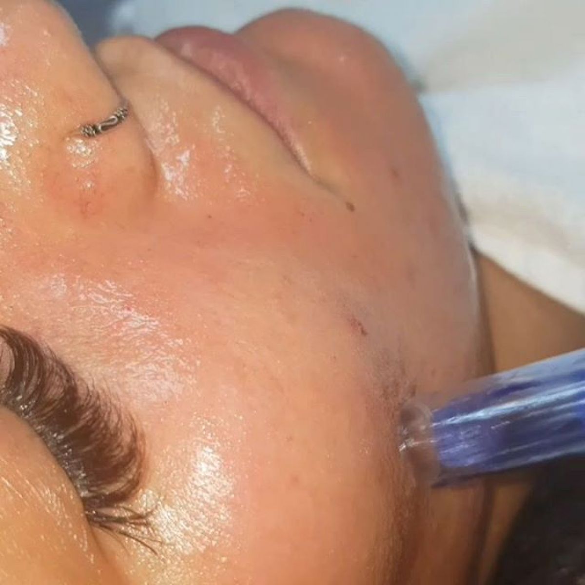 MicroNeedling BB Glow à Asnières-sur-Seine (92) Par Caroline - Estheca