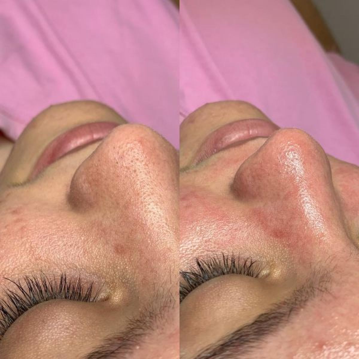 Hydraskin à Ris-Orangis (91) Par Vanessa - Estheca