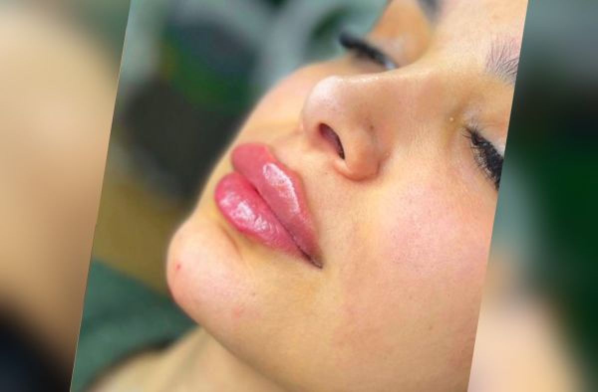 Augmentation des lèvres à Saint-Étienne (42) Par Armine - Estheca