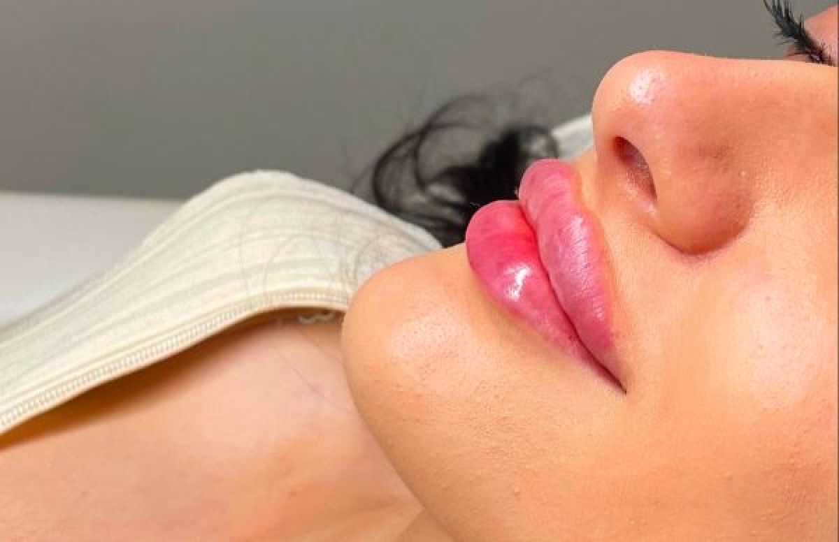 Augmentation lèvres sans injection à Fréjus (83) Par Gwendoline - Estheca