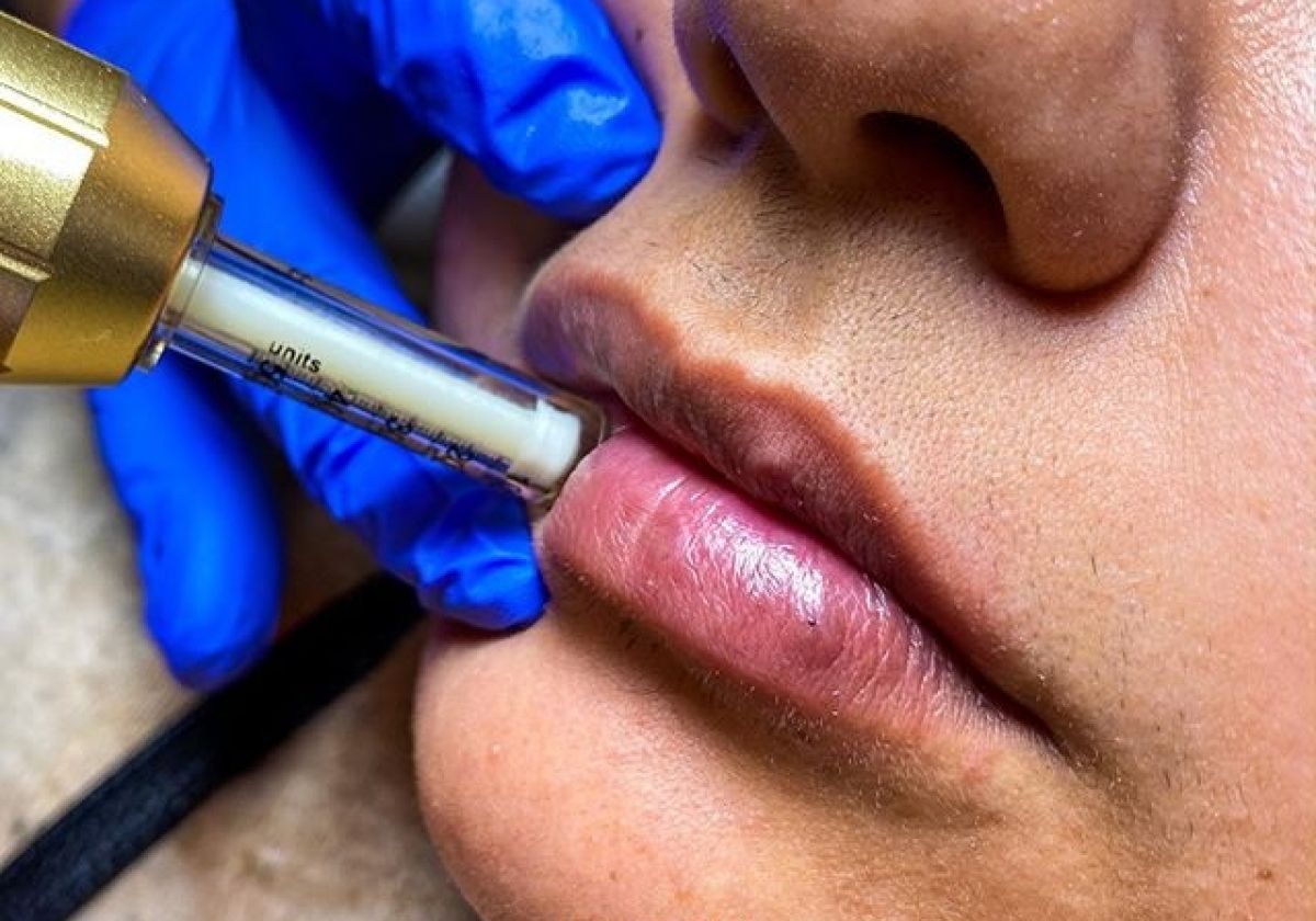 Hyaluron pen à Bessèges (30) Par Marine - Estheca