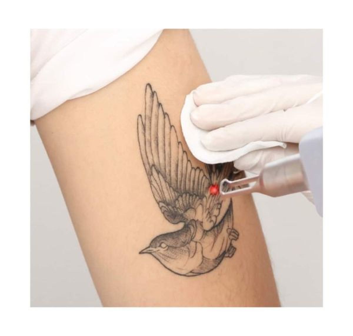 Detatouage à Épinay-sur-Orge (91) Par Virginie - Estheca