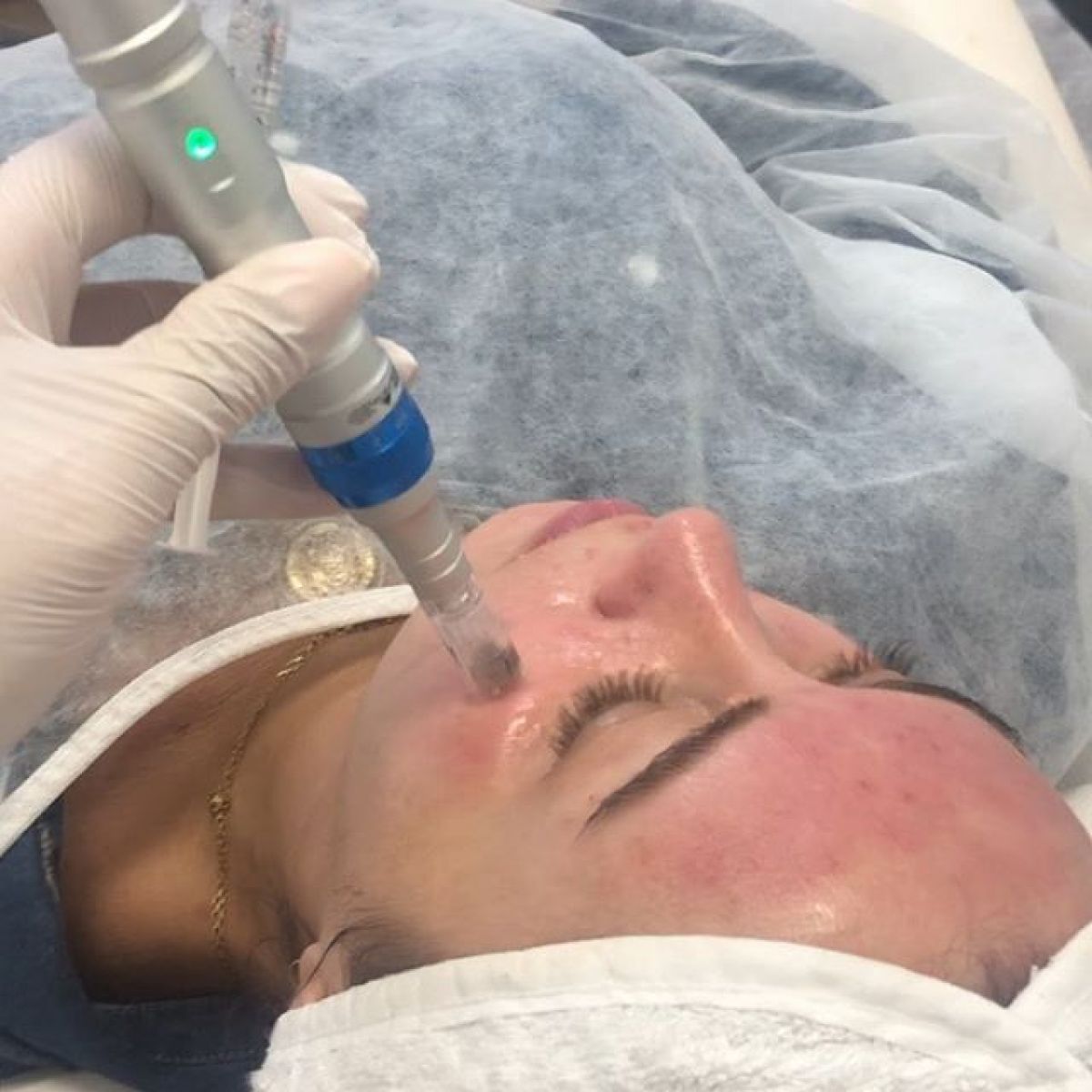 MicroNeedling BB Glow à Saint-Herblain (44) Par Mélissa - Estheca