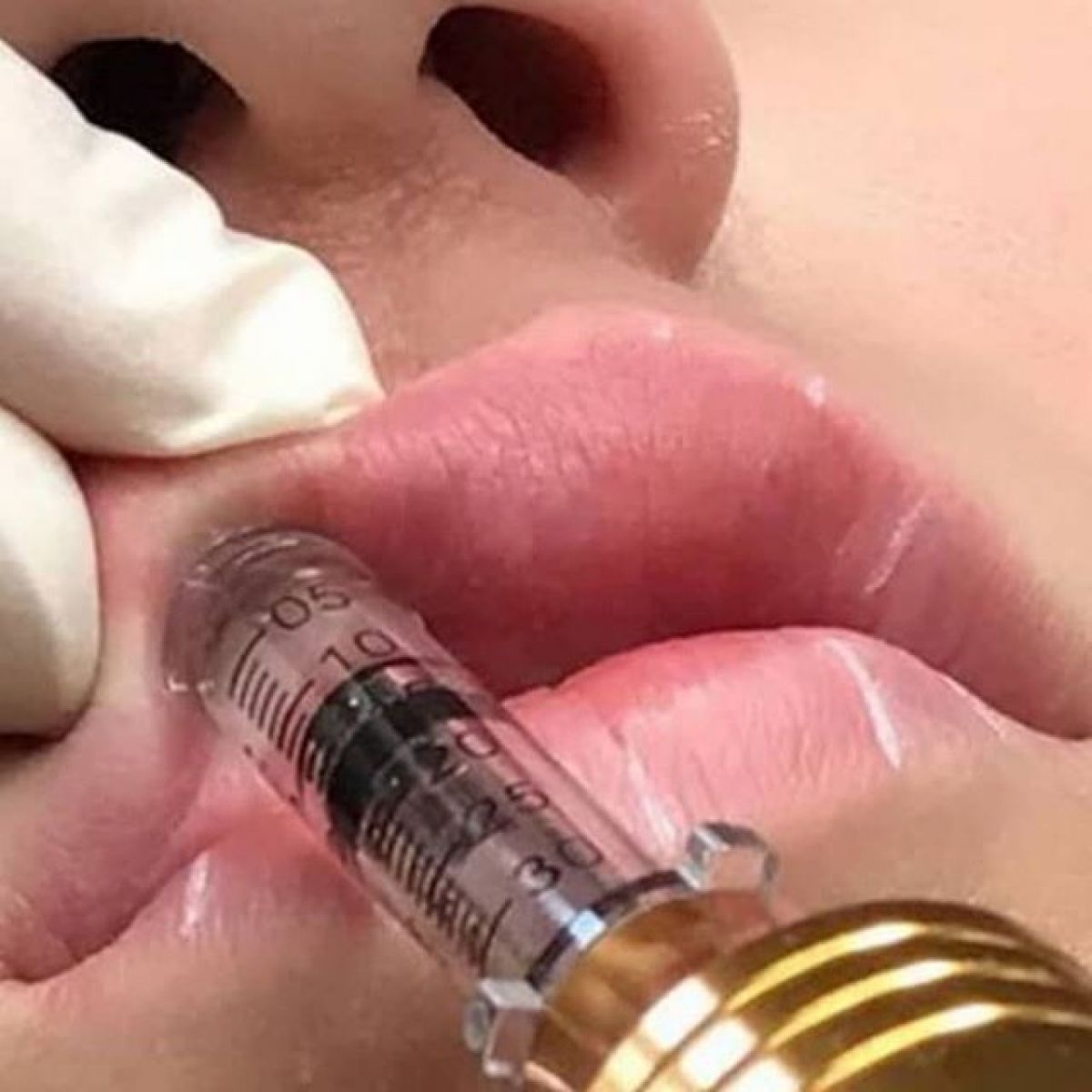 Hyaluron pen lèvres et rides à Neuilly-sur-Marne (93) Par Léa - Estheca