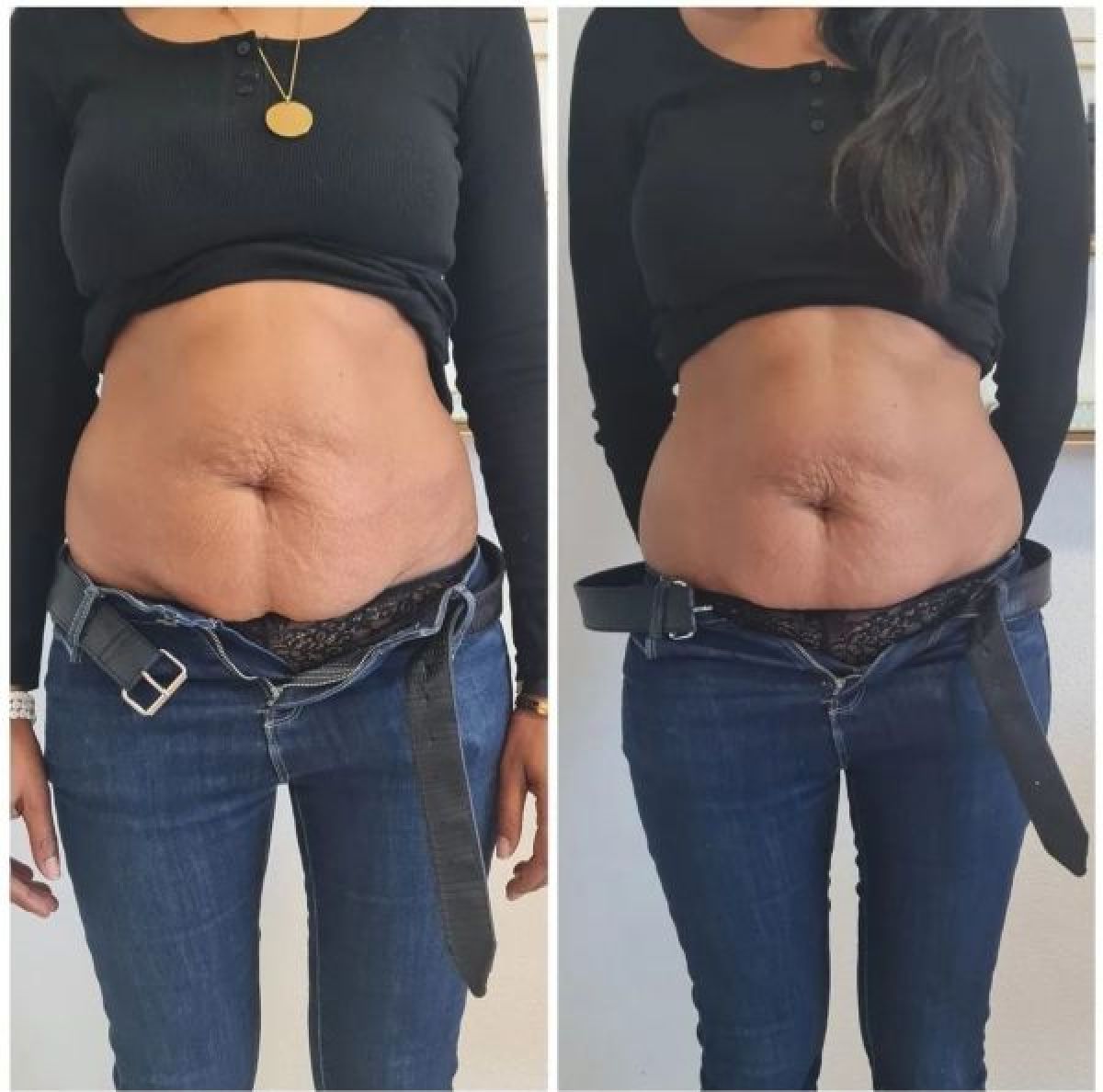 Amincissement et remodelage par lipocavitation / Radiofréquence à Meaux (77) Par Lilya - Estheca