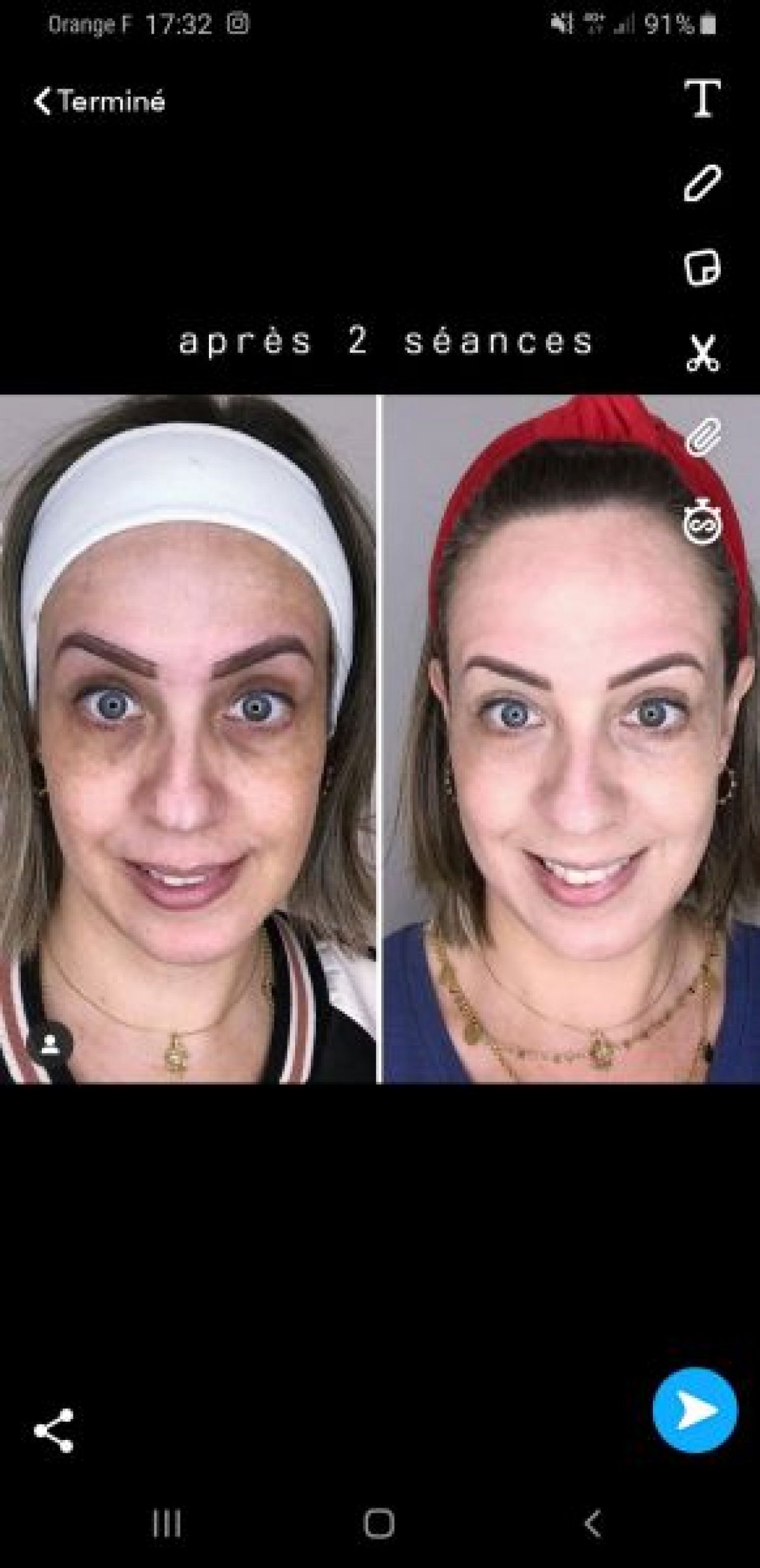 Microneedling BB GLOW à Sore (40) Par Maëlys - Estheca