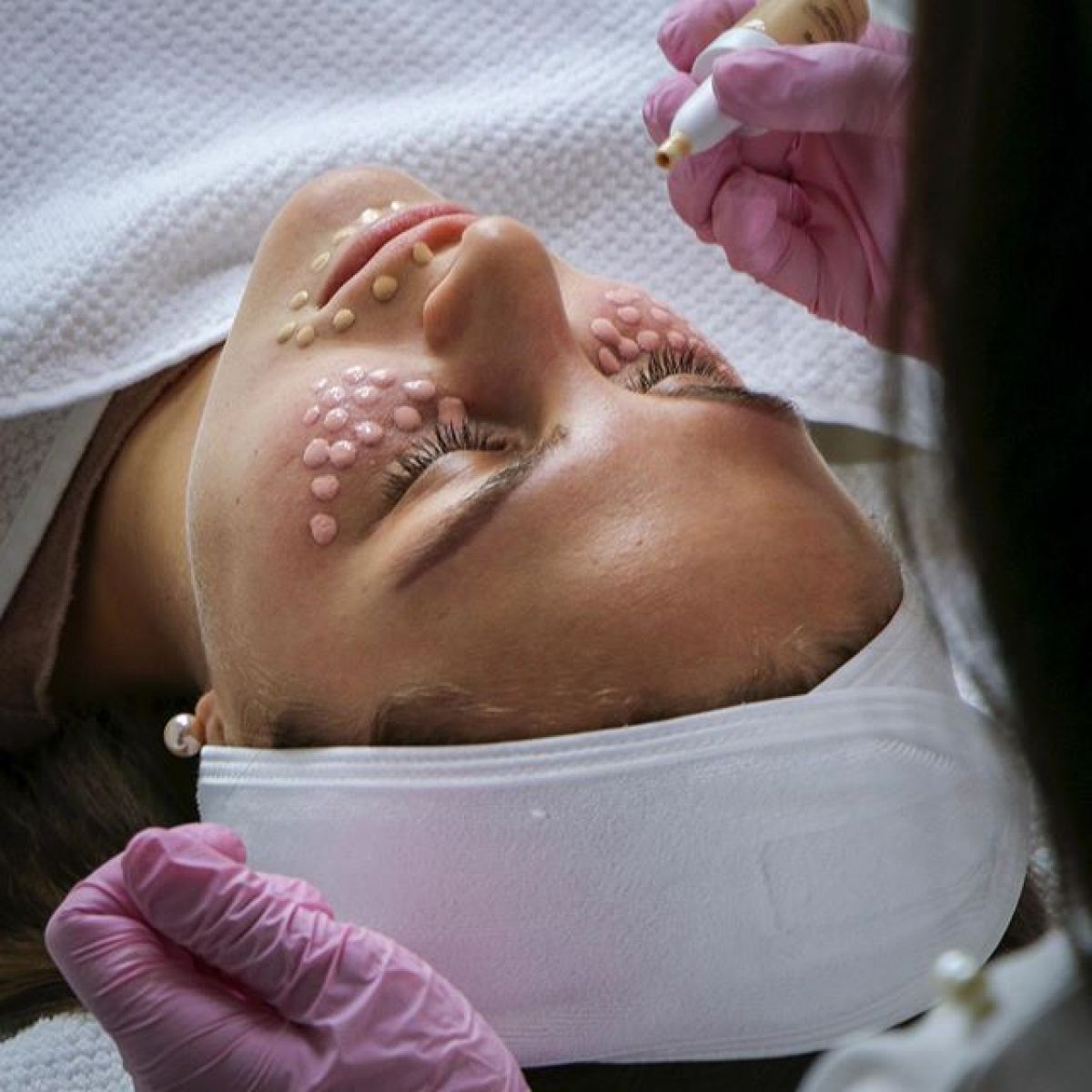 MicroNeedling BB Glow à Colomiers (31) Par Mélanie - Estheca