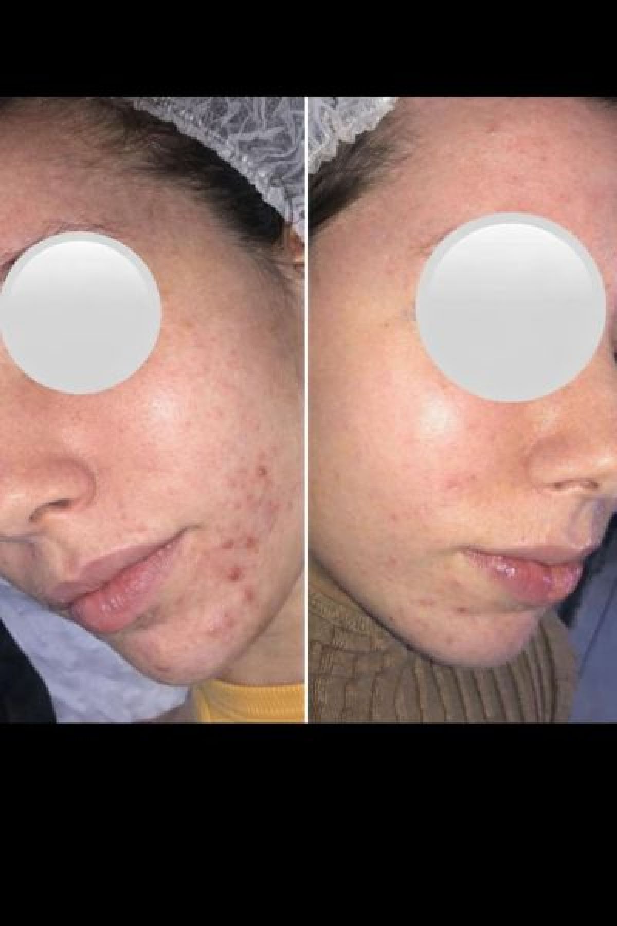 Microneedling à Brétigny-sur-Orge (91) Par Soukaïna - Estheca