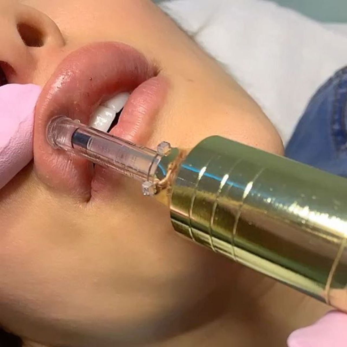 Hyaluron pen lèvres et rides à Villenave-d'Ornon (33) Par Laetitia - Estheca