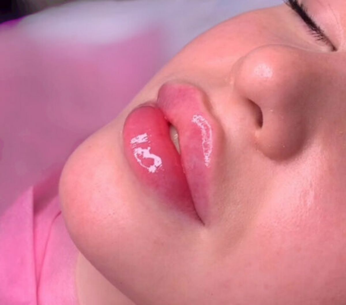 Russian lips Injection avec l’acide Hyaluronique à Cruseilles (74) Par Amandine - Estheca