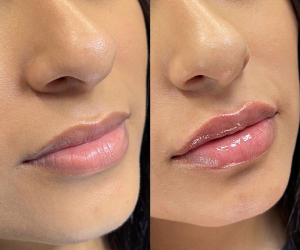 Russian lips, augmentation des lèvres, rides du lion et sillons sans injection à Lagny-sur-Marne (77) Par Khaby - Estheca