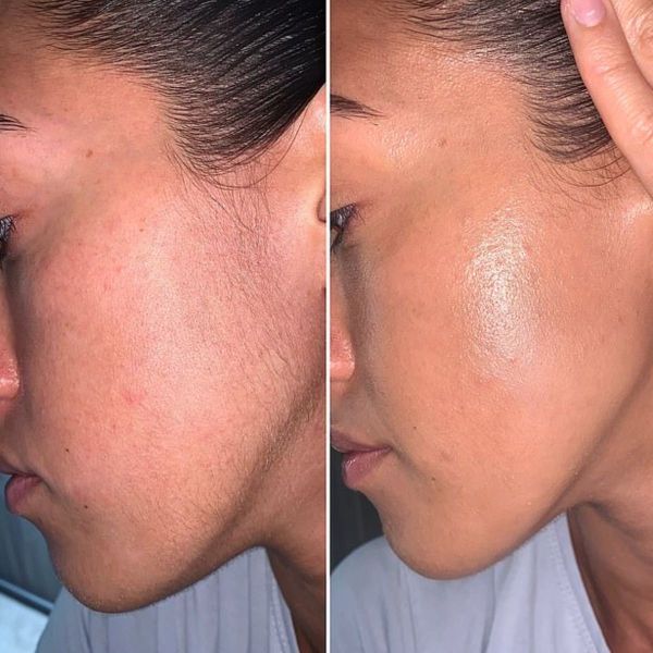 À Paris | Dermaplaning | Les meilleures esthéticiennes