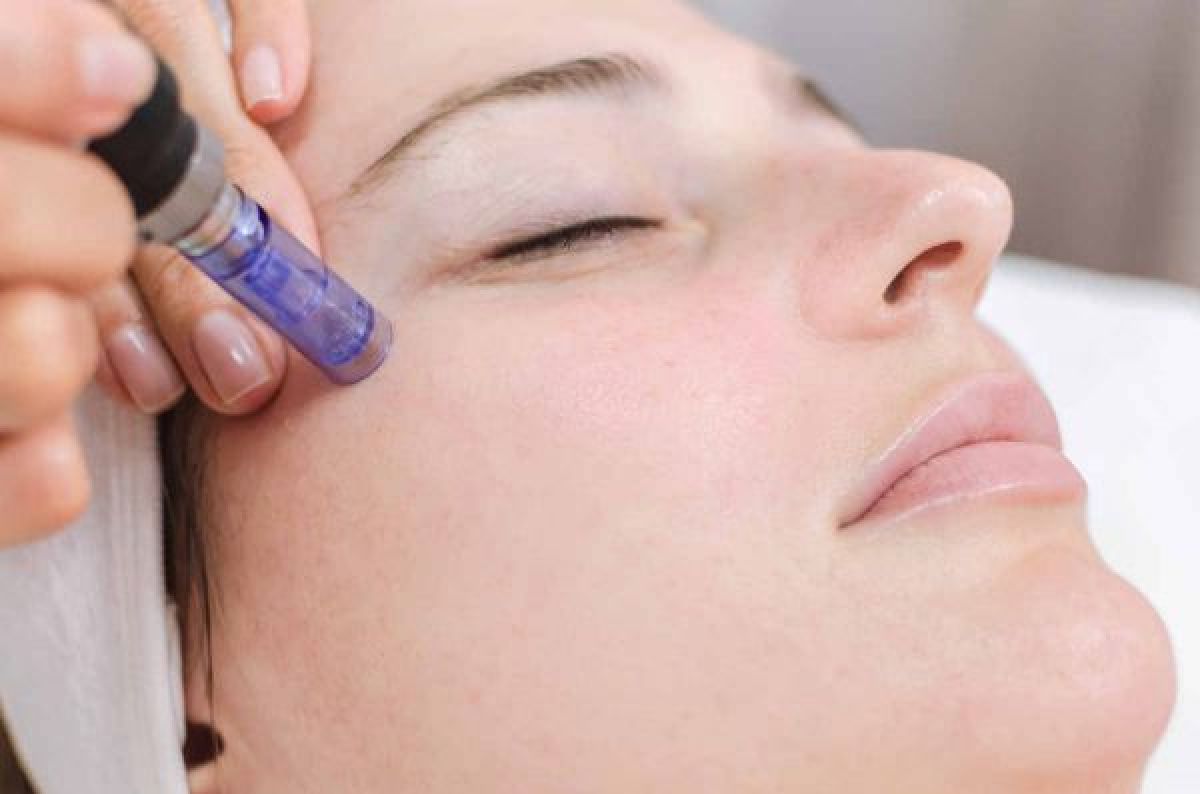 Microneedling / BB GLOW à Rebais (77) Par Mariana - Estheca