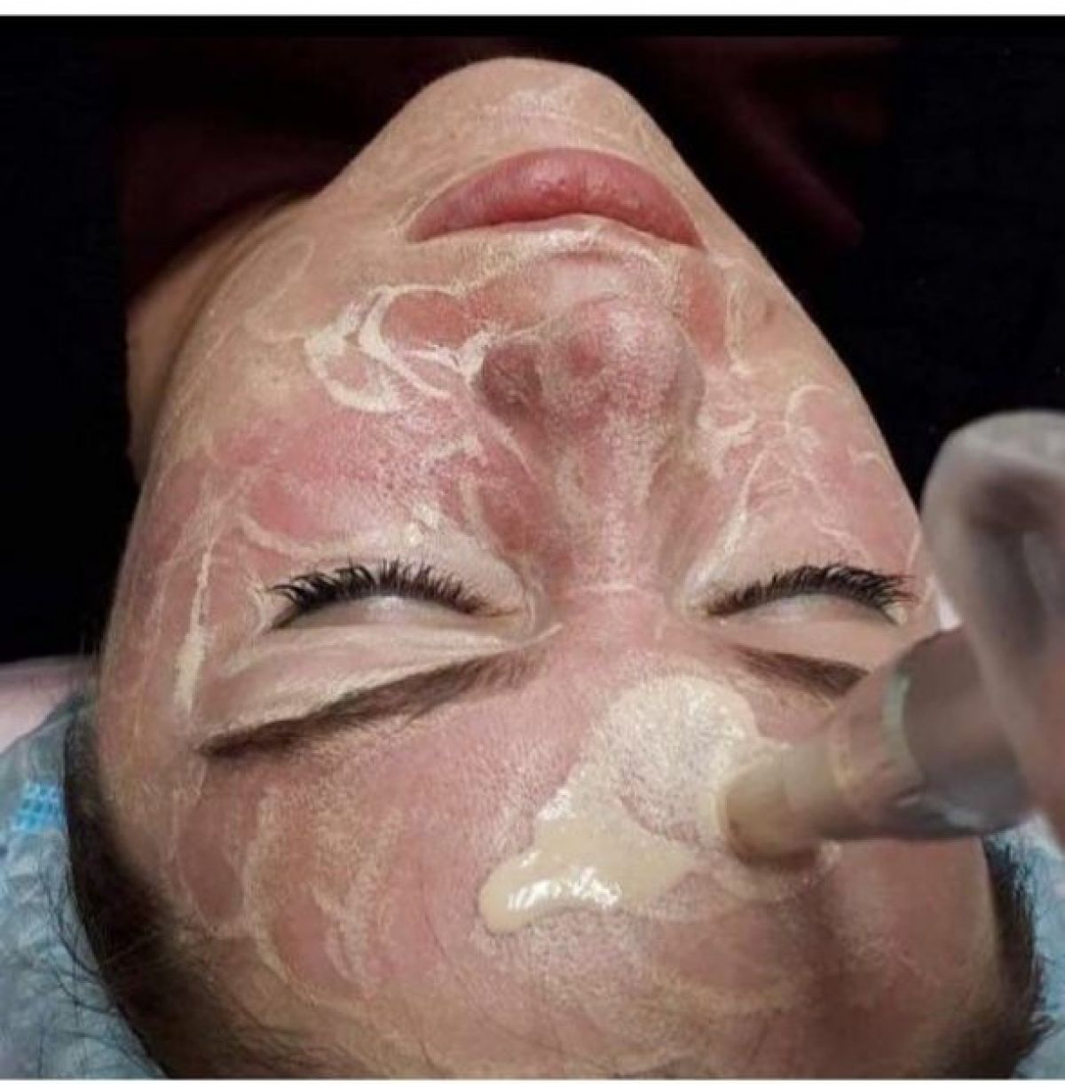 Microneedling/ Peeling/ BB Glow à Roubaix (59) Par Ines - Estheca
