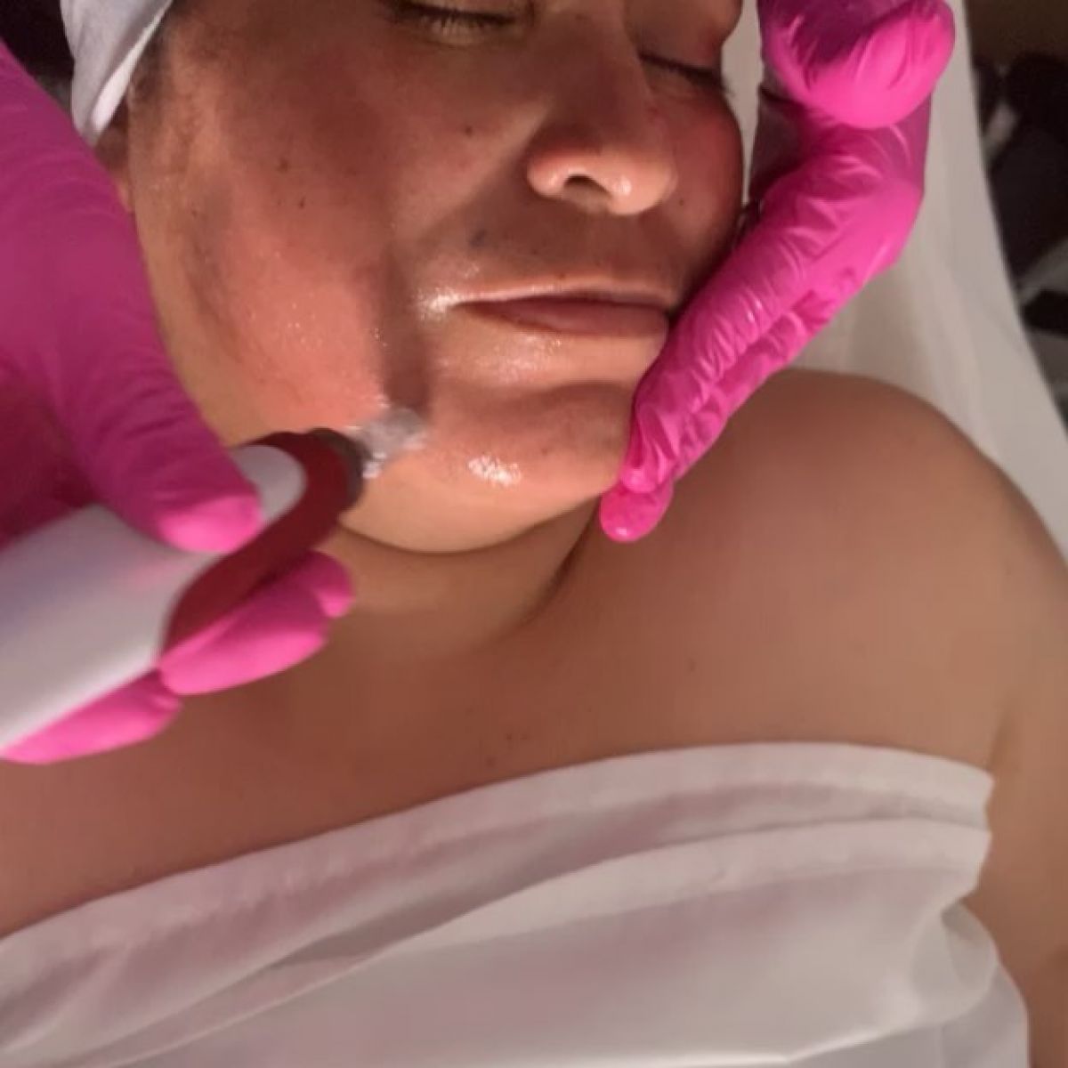 MicroNeedling BB Glow à Plaisance-du-Touch (31) Par Mathilde - Estheca