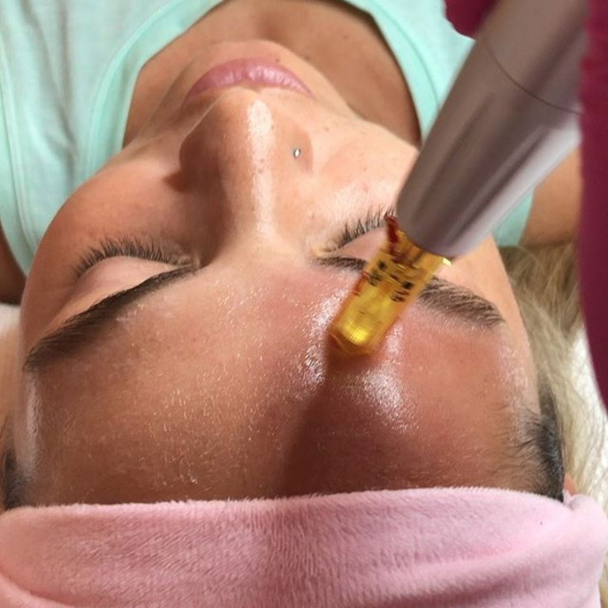 MicroNeedling BB Glow à Villejuif (94) Par Sandy - Estheca