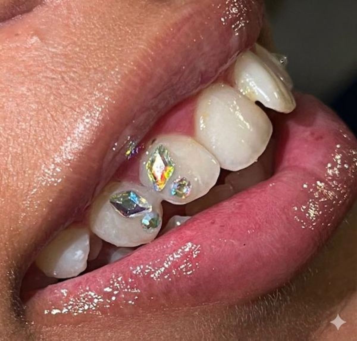 Strass Dentaire à Bourg-de-Péage (26) Par Laurine - Estheca