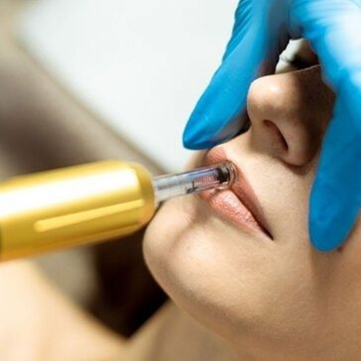 Hyaluron pen lèvres et rides à Frontignan (34) Par Manon - Estheca