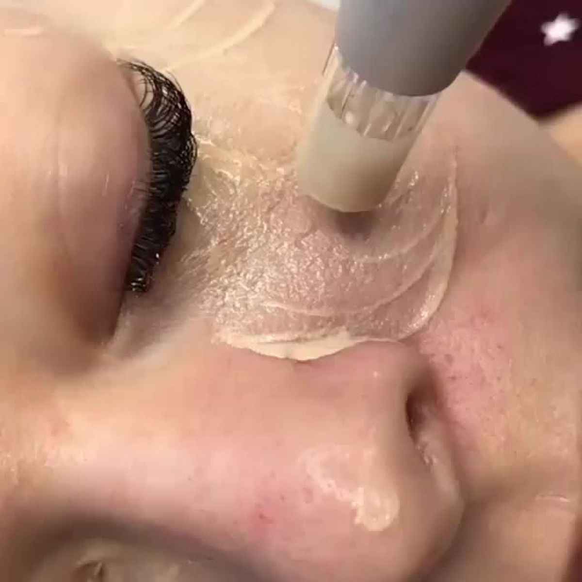 MicroNeedling BB Glow à Courbevoie (92) Par Amandine - Estheca