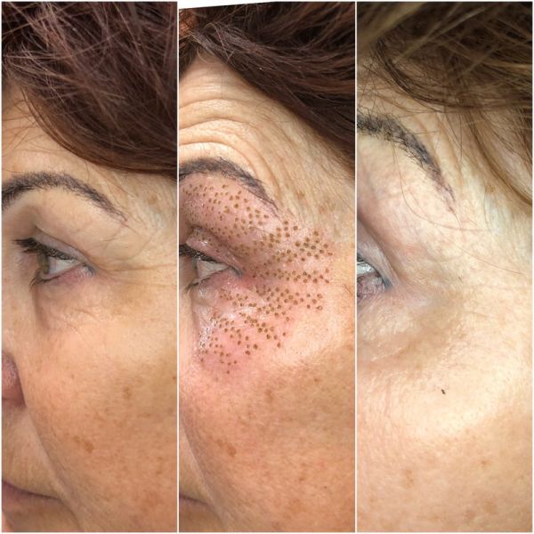 Lot De 30 Aiguilles Pour Stylo Plasma Fibroblaste - Raffermir La Peau, Réduire Rides & Enlever Grains De Beauté