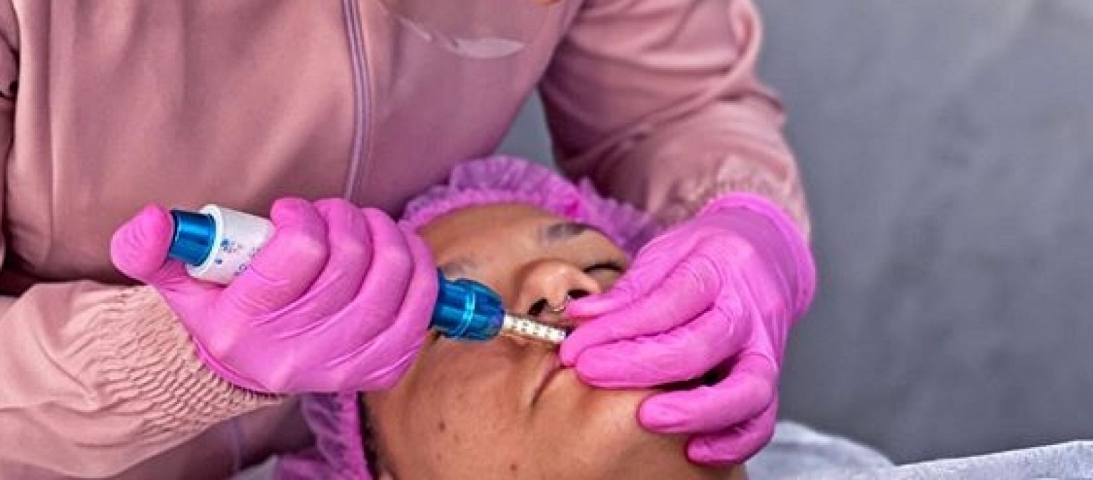 Hyaluron pen lèvres et rides à Bouc-Bel-Air (13) Par Alexiane - Estheca