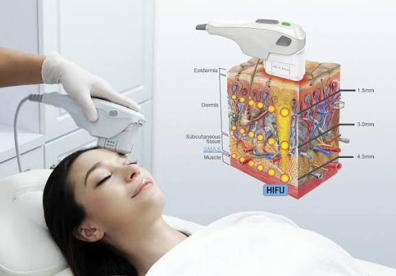 À Guénange | Hifu lifting sans chirurgie | Les meilleures esthéticiennes