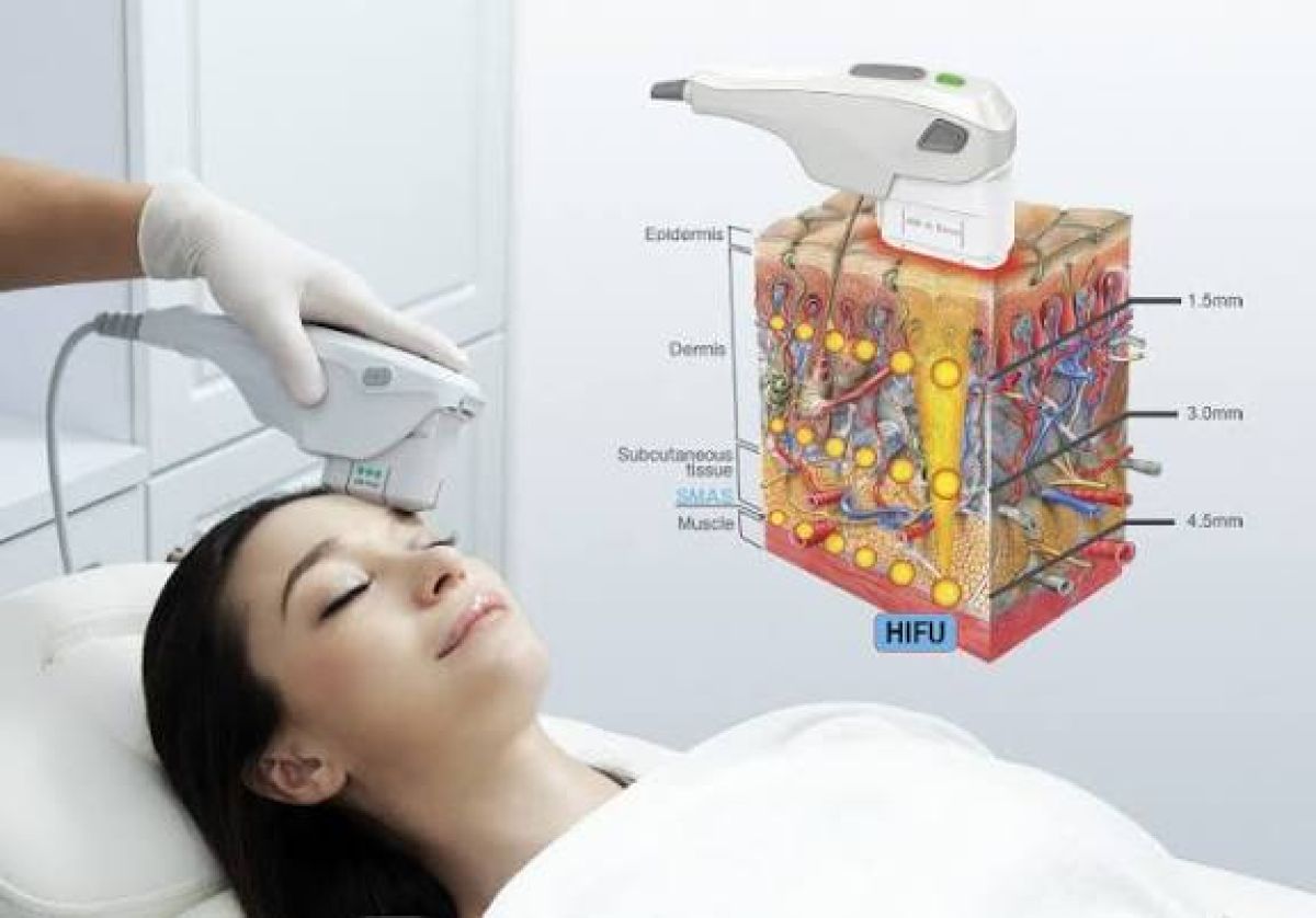 Hifu lifting sans chirurgie à Guénange (57) Par Magalie - Estheca