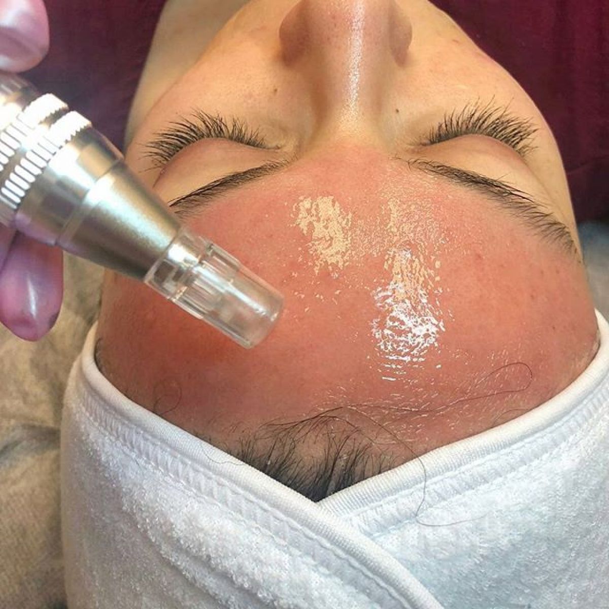 MicroNeedling BB Glow à Aulnay-sous-Bois (93) Par Charlotte - Estheca