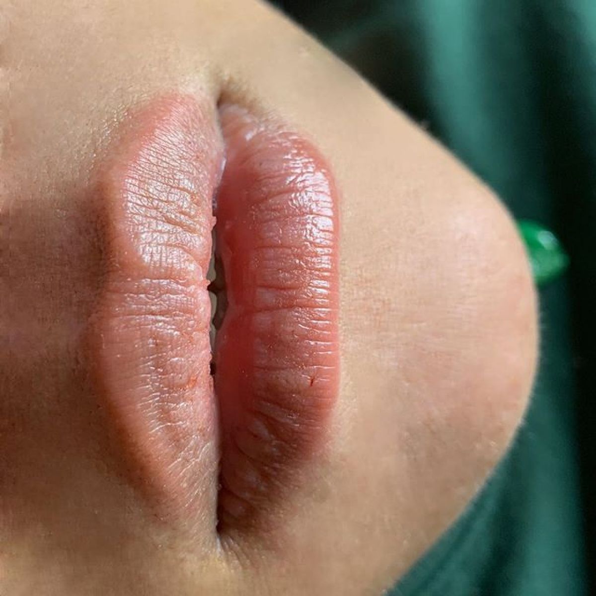 Augmentation des lèvres HyaluronPen à Villejuif (94) Par Sandy - Estheca