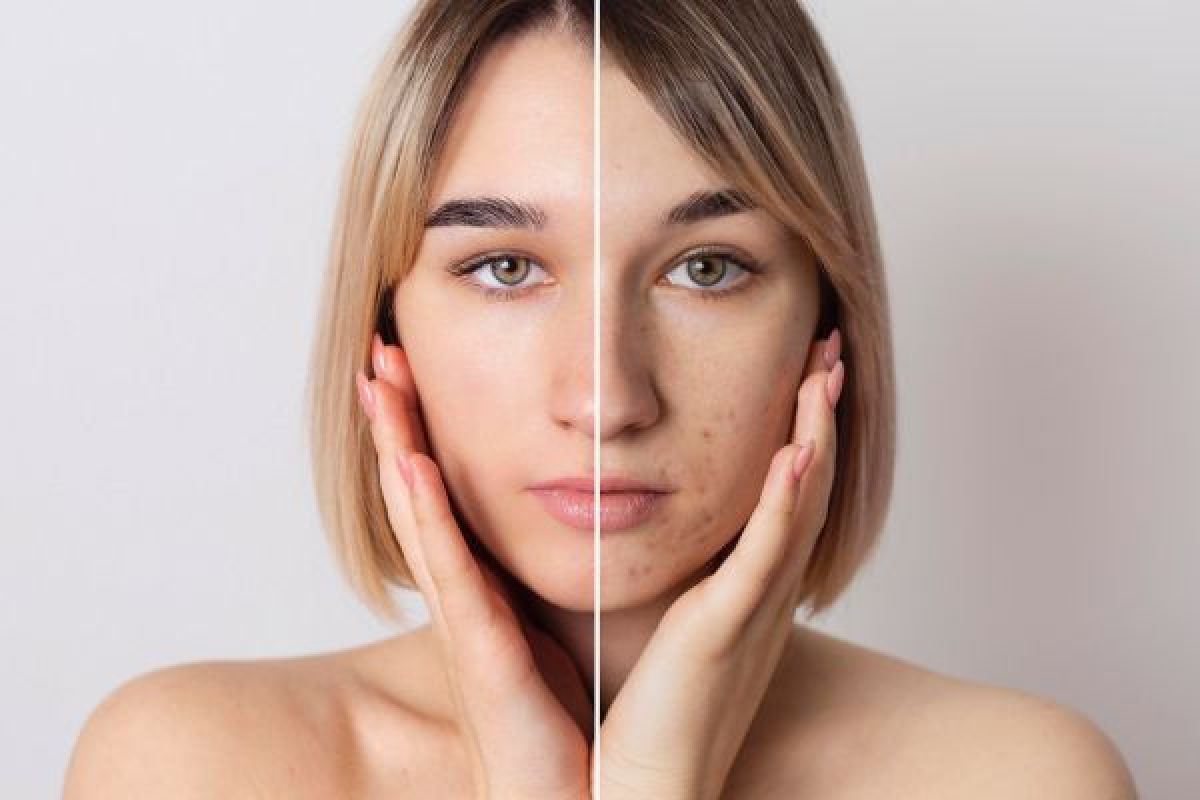 Mésothérapie visage à Orvault (44) Par Wissal - Estheca