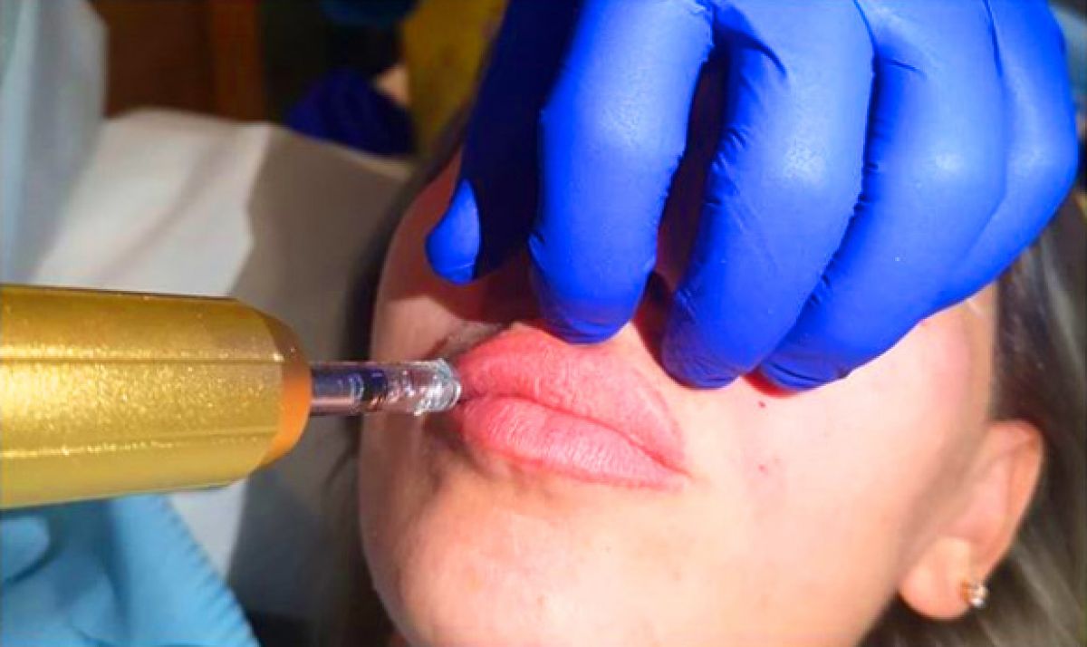 Augmentation des lèvres par Hyaluron pen  à Marcq-en-Baroeul (59) Par Myriam - Estheca