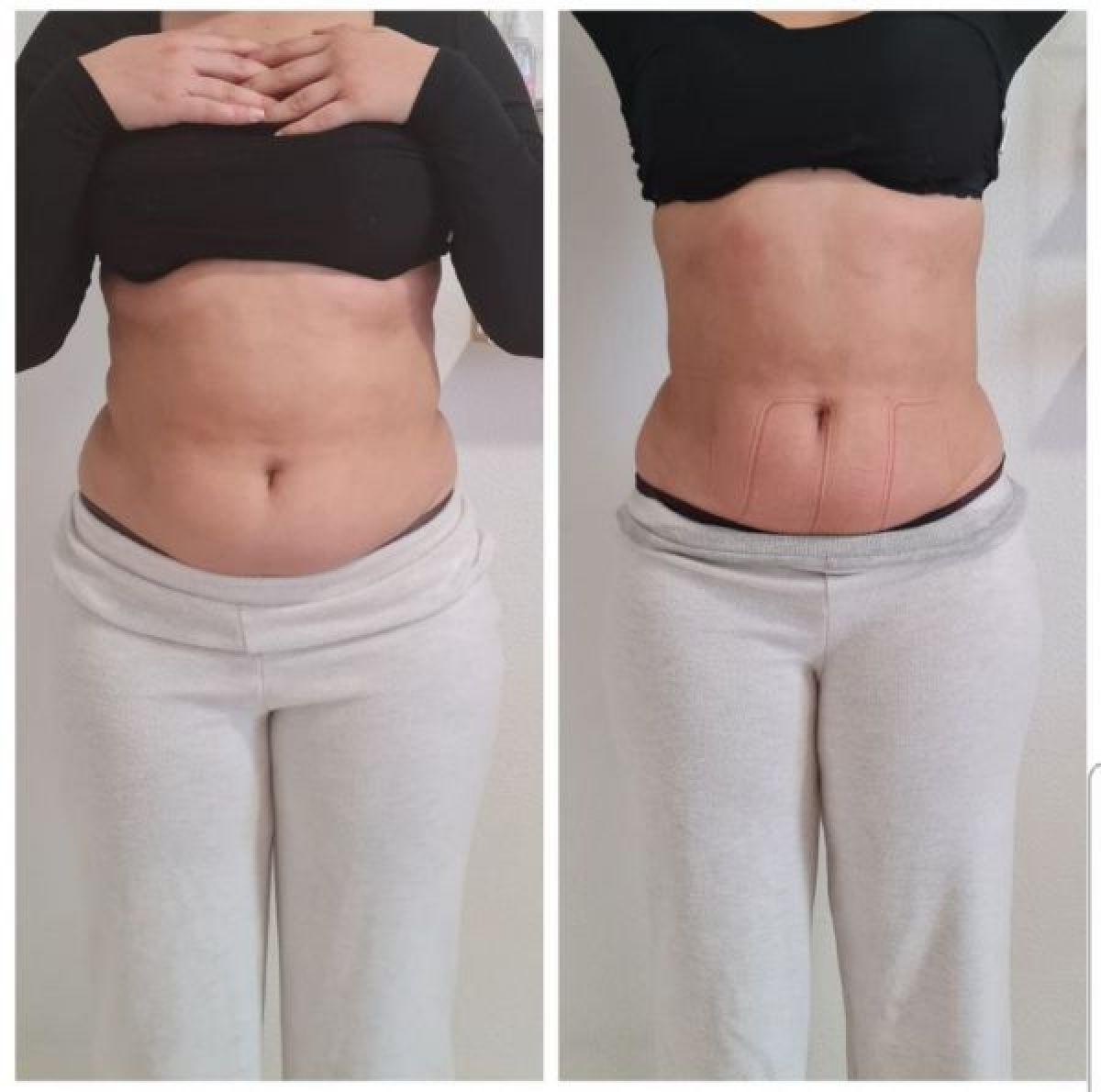 Amincissement et remodelage par lipocavitation / Radiofréquence à Meaux (77) Par Lilya - Estheca