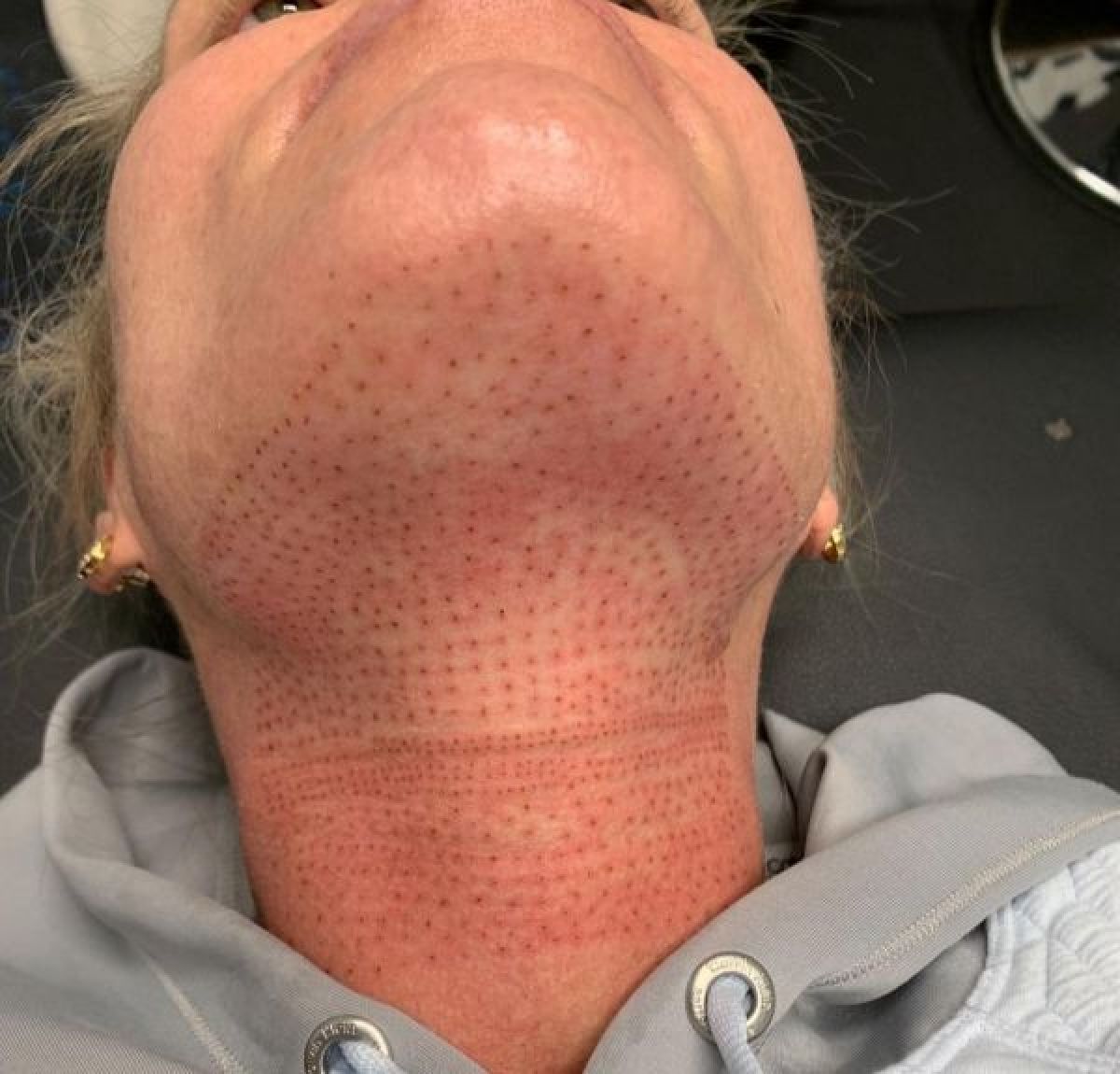 PlasmaLift à Antwerpen Par Dolly - Estheca