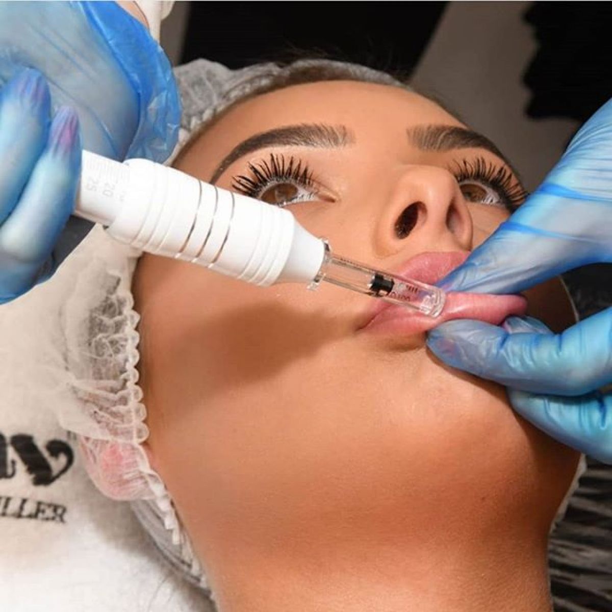 Augmentation des lèvres Hyaluron pen à Monnetier-Mornex (74) Par Maud - Estheca