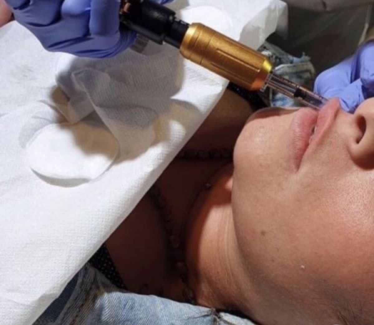 Formation Hyaluronpen à Paris (75) Par Maya - Estheca