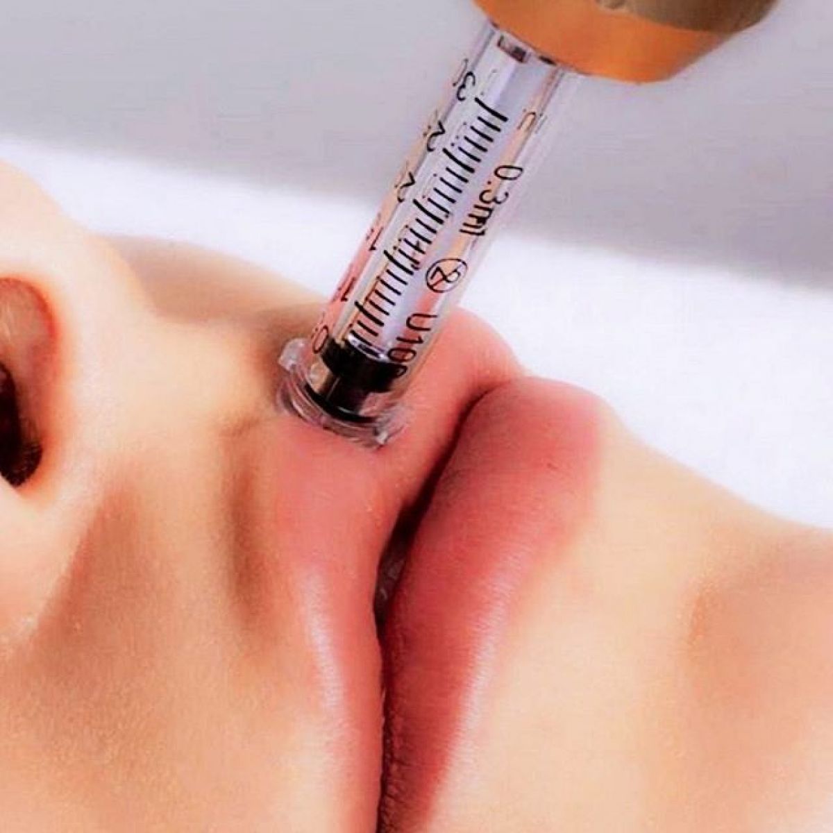 Hyaluron pen Lèvres à Saint-Denis (93) Par Yasmine - Estheca