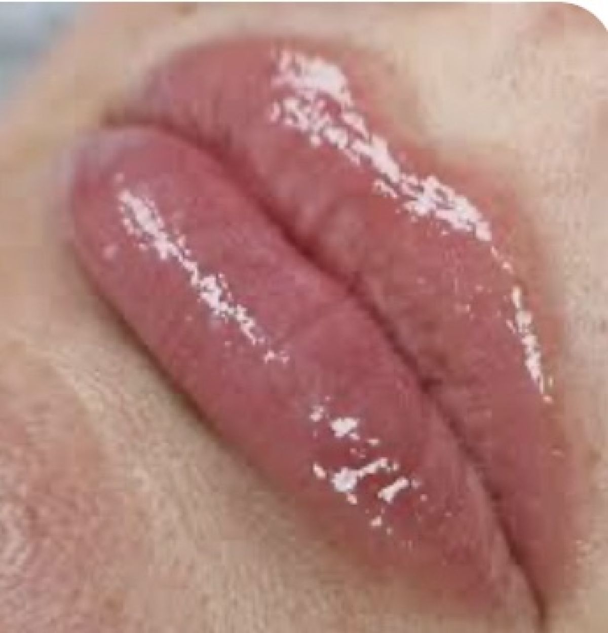 Hydra lips à Grenoble (38) Par Andrea - Estheca