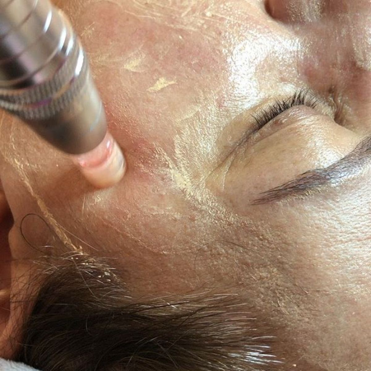 MicroNeedling BB Glow à Villeneuve-Loubet (06) Par Amandine - Estheca