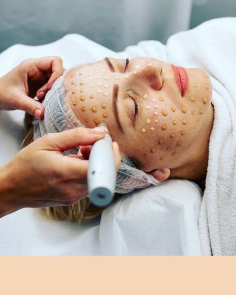 À Rennes | Microneedling/BB GLOW | Les meilleures esthéticiennes